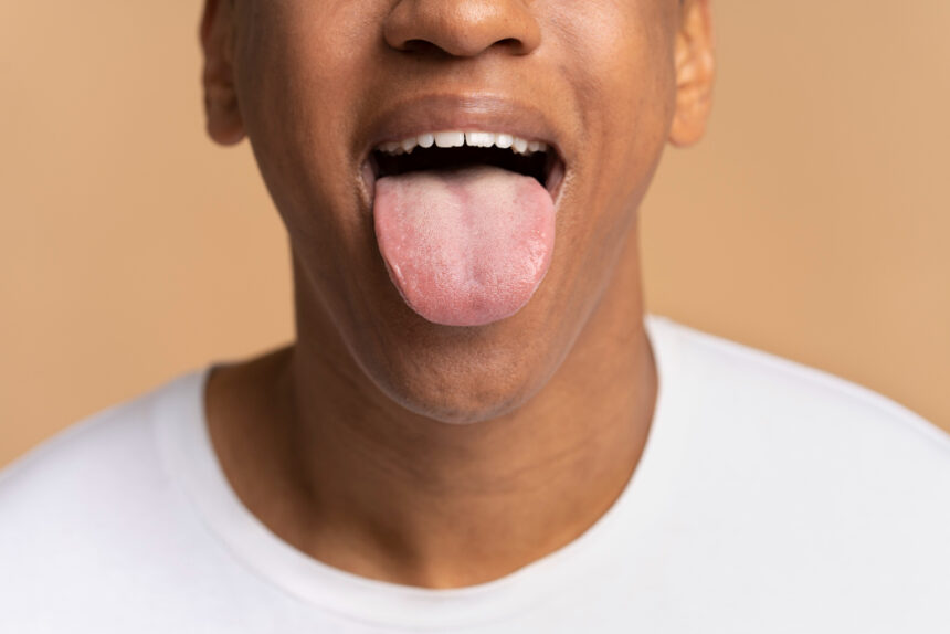 A tongue disease that some call this and you will find that it is called a throat disease, is a disease of the pharynx that causes it to lie down and spread to the throat