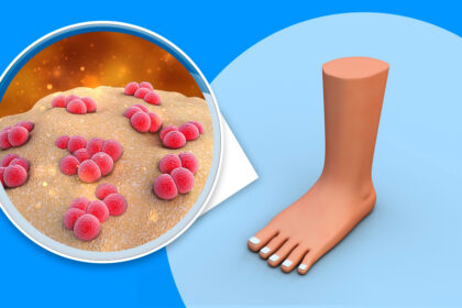 What can you do to prevent diseases caused by excessive sweat in your feet