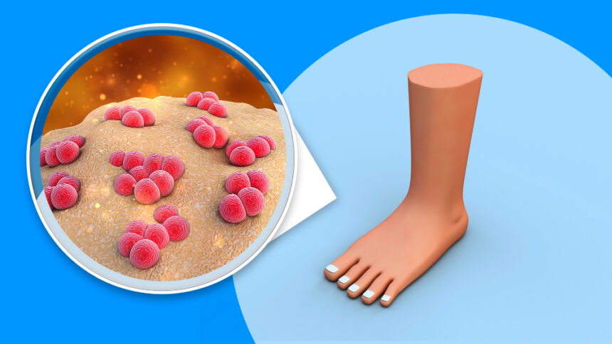 What can you do to prevent diseases caused by excessive sweat in your feet